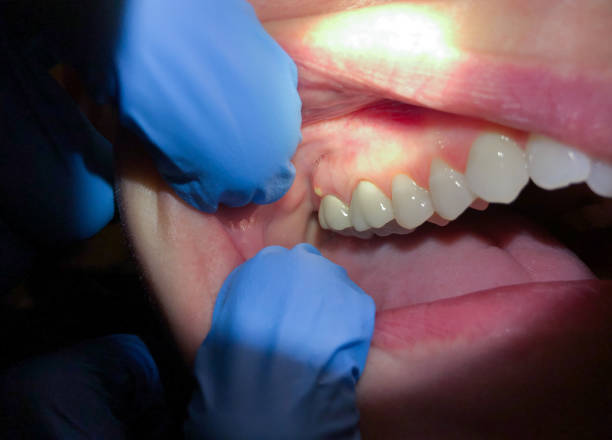 Best Emergency Tooth Extraction in Camp Croft, SC